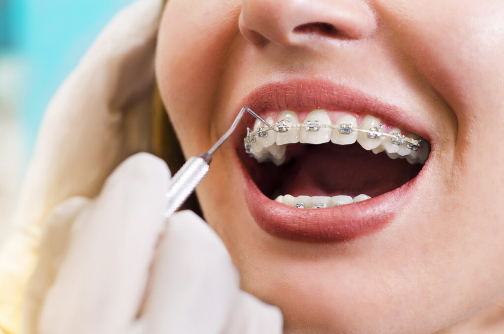 Can Adults Still Benefit from Orthodontic Treatment?